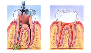 Root canal procedure